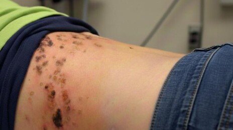 “감기몸살인줄 알았는데”…방치시 평생 신경통 ‘이 질환’