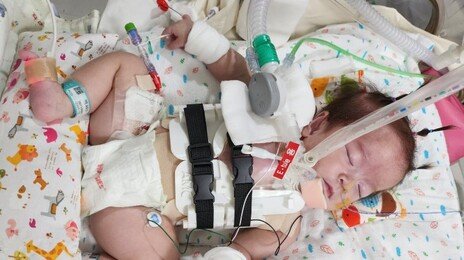 “심장이 몸 밖에”…생존 힘들다던 서린이, 기적을 만들었다