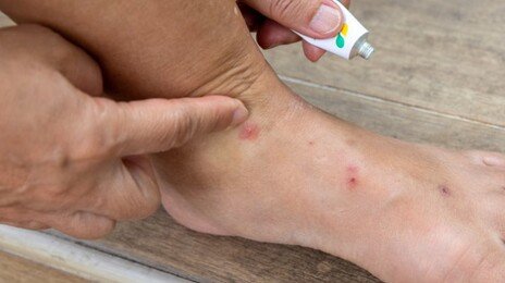 “비행기서 빈대 나와 여행 망쳐” 3억 원대 소송