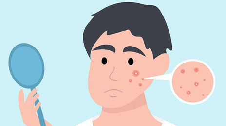 여드름 잘 나는 피부엔 약산성 세안용품이 적합