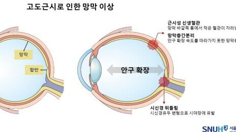 ‘고도 근시→시력 손상’ 이어져…정기 안과검진 필수