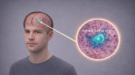 50세 이하에서 흔한 난치성 뇌종양 ‘기원세포’ 규명
