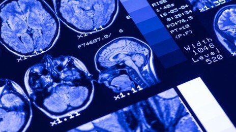 “70대 환자 뇌인줄”…꽃다운 24세 집어삼킨 치매