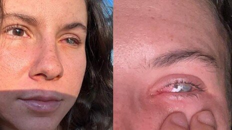 “버스 탔다가 눈 비볐을 뿐인데” 20대 女 실명…이유는?