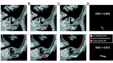 귓불의 사선 주름 ‘프랭크 징후’와 심뇌혈관질환 연관성 밝혀졌다