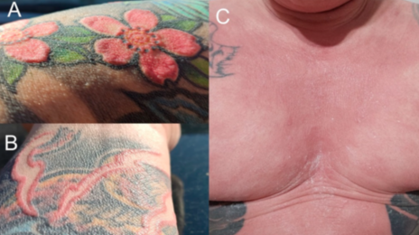 “붉은색 문신했다가” 전신 탈모, 피부 박탈, 무한증까지…