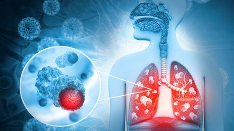 감기와 증상 비슷한 폐렴…‘이 질환’ 환자들엔 더 치명적