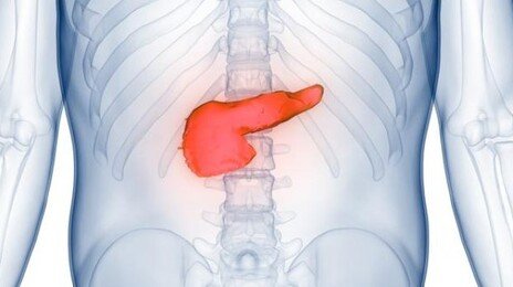 암 생존율 70% 시대, 췌장암만 한·미·일 10%대… 왜?
