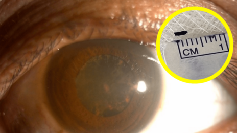 “앗! 눈에 티끌”…2년 방치했다가 실명 위기…알고보니 ‘쇳조각’