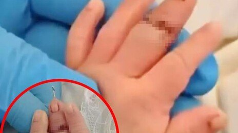 탯줄 자르다가 아기 손가락 절단…中간호사 황당 실수