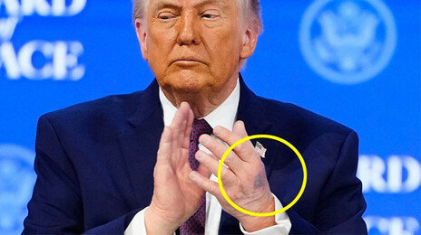 트럼프 손등에 또 멍자국…“테이블에 부딪혔다” 해명