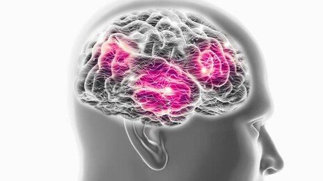 암과 치매의 역설적 관계 …치료 힌트, 암세포가 쥐고 있다?