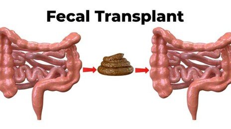 건강한 사람의 대변 이식, 암 치료의 ‘새 돌파구’ 될까