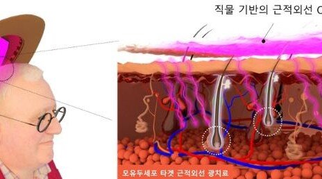 카이스트, 모자처럼 쓰는 탈모 예방 OLED 개발