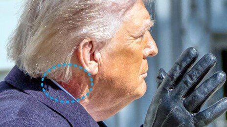 트럼프 목에 선명한 붉은 반점…백악관 “피부 크림 탓”