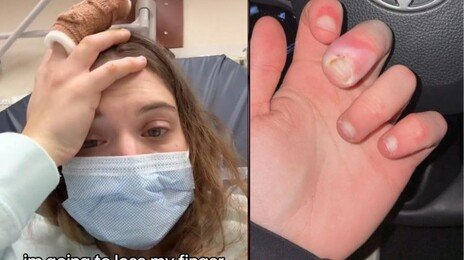 손톱 거스러미 물어뜯다가 “손가락 절단할 뻔”…조직 괴사