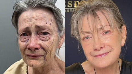 “30년 젊어졌다”…70세 여성, 안면거상 결과에 네티즌 감탄