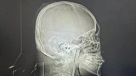 취중에 젓가락 꿀꺽, 목에 박혀…8년 지나서야 제거 수술