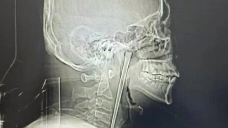 취중에 젓가락 꿀꺽, 목에 박혀…8년 지나서야 제거 수술