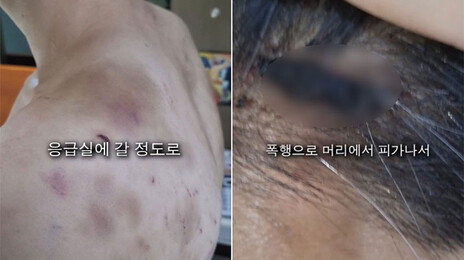 “다락방 가두고 요강 대소변에 폭행”…중국집 직원 온몸 ‘피멍’