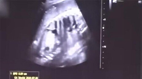 ‘36주 낙태’ 20대女, 50대 교제남이 수술비 내주고 떠났다