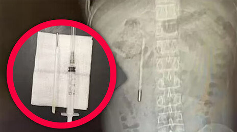 20년전 삼킨 수은 체온계가 뱃속에…“혼날까봐 말 안해”