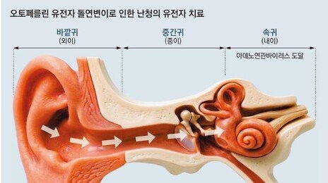 ‘정상 유전자’를 난청 환자 귀에 주입… “소리가 들려요”
