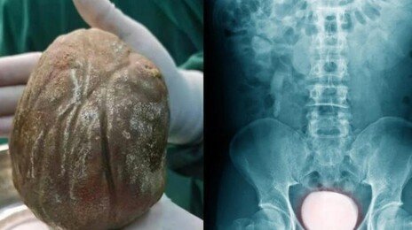 3년간 소변 볼 때 극심한 통증…방광서 1.3kg 초대형 결석 나와