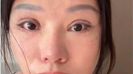 “눈이 안 감겨요”…무허가 쌍꺼풀 수술한 中여성 장애 판정