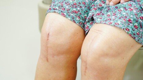 무릎·고관절 수술 괜찮을까? 노인 15%, 심각한 인지 저하 궤적