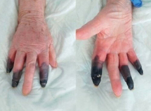 “I didn’t know about the infection…  ”Finger necrosis → amputation due to corona sequelae