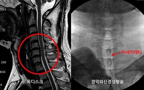 Neuroplasty (신경 관개) 검토 - 자궁 경부 디스크 자궁 경부 디스크 후방 목 교정 목 거북목 치료