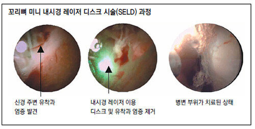 헬스동아]Mri도 못 찾는 허리 통증 잡는다… 꼬리뼈 내시경 레이저 '눈길'｜동아일보