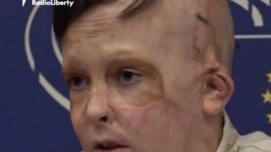 母 잃고 36번의 수술 이겨낸 우크라 소년의 호소 “계속 도와주세요”