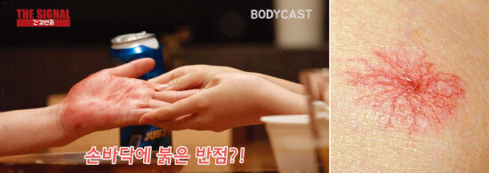 손바닥에 붉은 반점이 나타나는 수장홍반증(왼쪽 사진)이나 피부에 거미 다리 모양으로 붉게 보이는 거미혈관종(오른쪽 사진)은 간경변증 시그널이다.  [‘THE 시그널’ 영상 캡쳐]