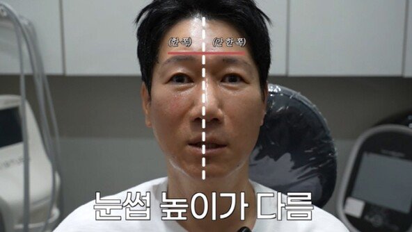 리프팅 시술한 59살 지석진 “효과 이 정도였냐” 감탄