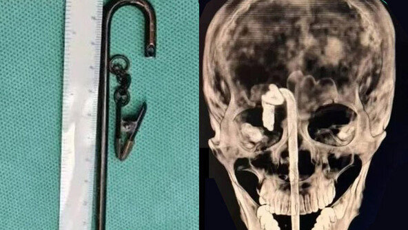 술 취해 넘어진 男, 40cm 쇠막대 뇌에 꽂혀…기적 생존