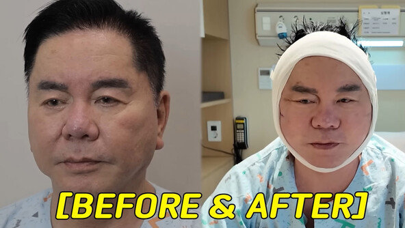 심형래, 안면거상술 받았다…“얼굴 리모델링 해 유튜브”