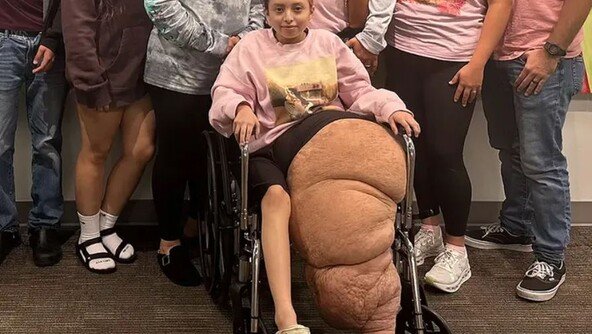 한쪽 다리만 79kg…희귀 질환에 美 10대 소녀 결국 절단 수술