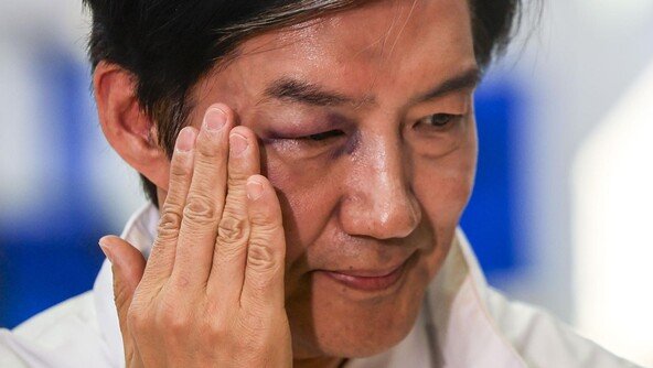 오른쪽 눈 붓고 멍든 채 후보자 등록한 조국…무슨 일?