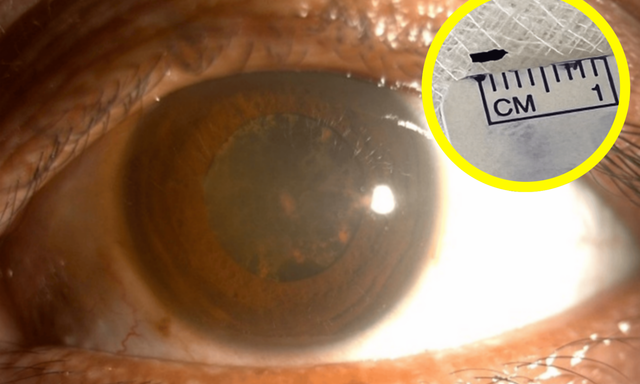 “앗! 눈에 티끌” 2년 방치했다 실명 위기…알고보니 ‘쇳조각’