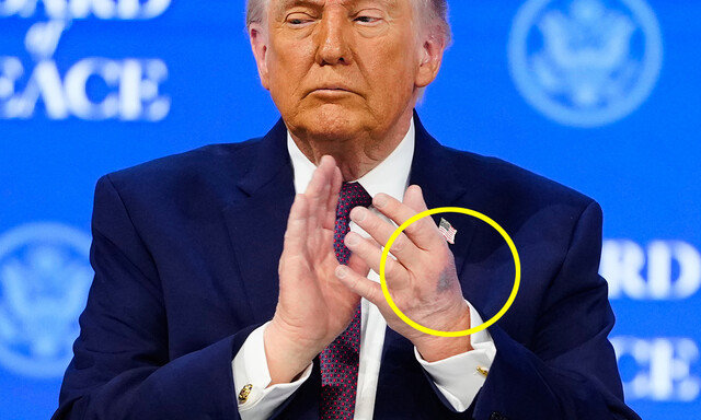 트럼프 손등에 또 멍자국…“테이블에 부딪혔다” 해명