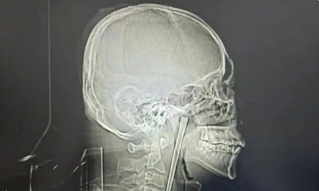 목에 12㎝ 젓가락 박힌 채로 8년 지낸 남성…뒤늦게 제거 수술