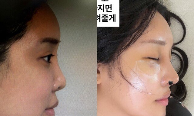 랄랄 맞아? 눈밑지+코 수술 후 확 달라진 근황…“착해진 거 같기도” [DA★]