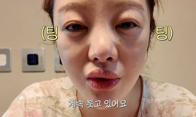 황보라, 시험관 주사 부작용으로 얼굴 ‘퉁퉁’…“온몸 붓고 각막까지 찢어져”