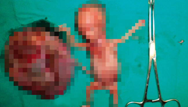 워마드에 올라왔던 낙태 인증 사진. 확인 결과 태아 모형인 것으로 밝혀졌다. [동아DB]