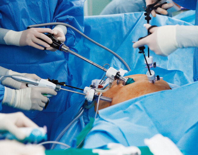간호사가 복강경 카메라로 시야를 확보하고 보조 의사가 대장을 잡아주면, 집도의가 배꼽 주변에 낸 작은 구멍으로 기구를 넣어 암 덩어리를 잘라낸다. [박해윤 기자]