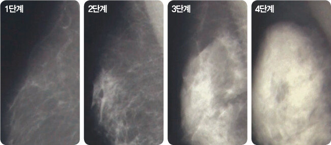 치밀 유방 단계 변화 모습. [사진 제공 · KMI]