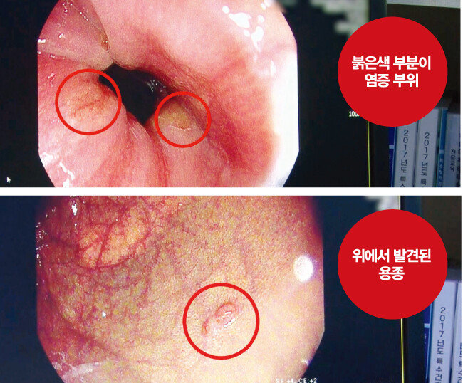 남혜정 건강캐스터의 위내시경 검사 사진