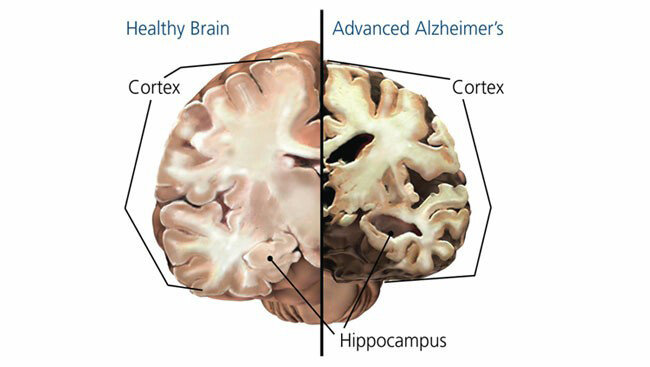 정상 뇌와 알츠하이머에 걸린 뇌. [brainfacts.org]